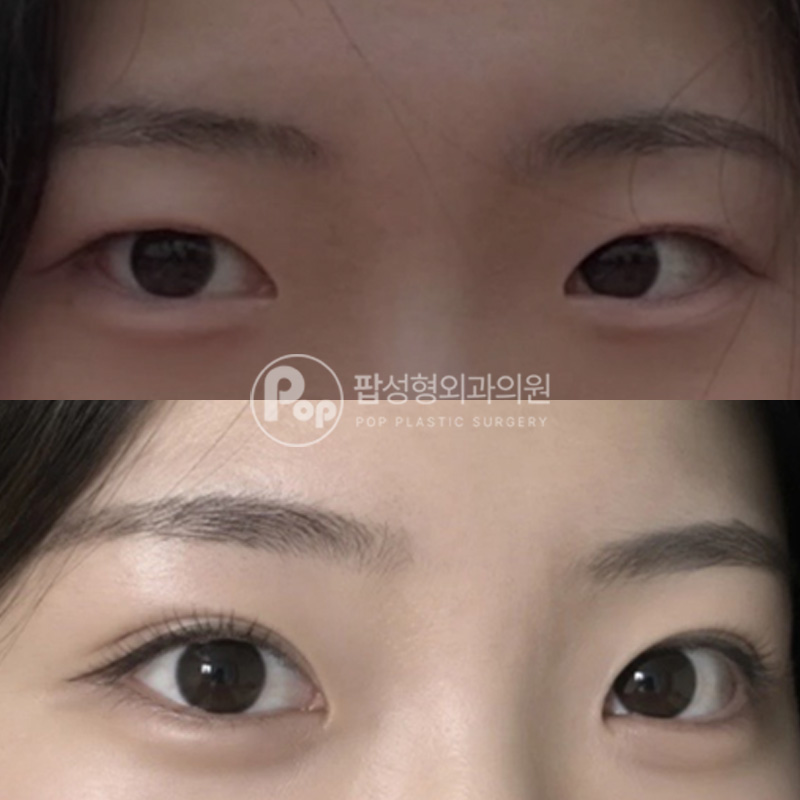 팝성형외과 풀린눈 인아웃라인 재수술 리뷰