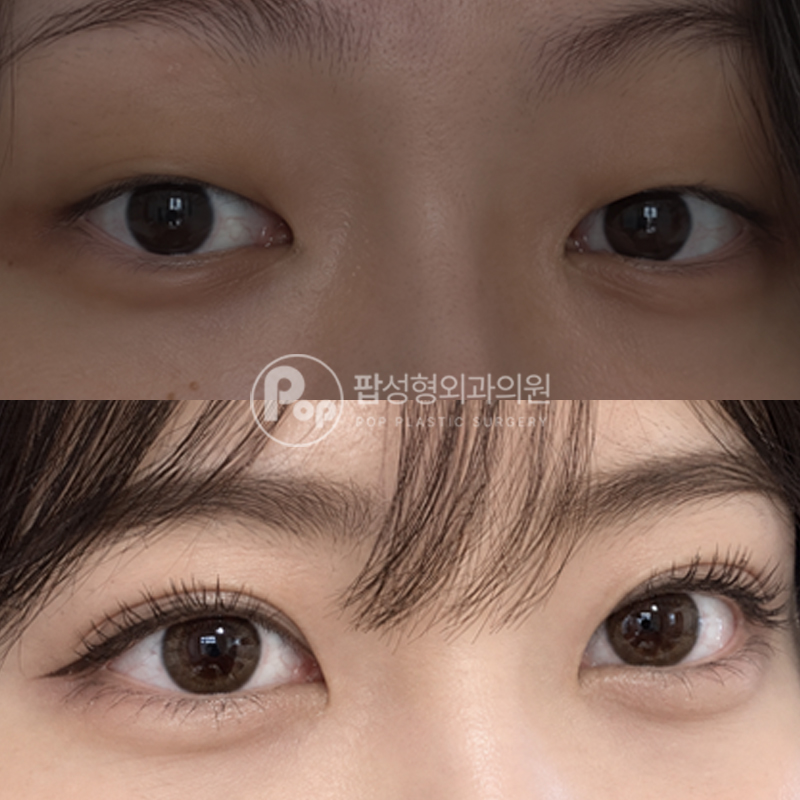 팝성형외과 무쌍 인아웃 자연유착 트임 후기