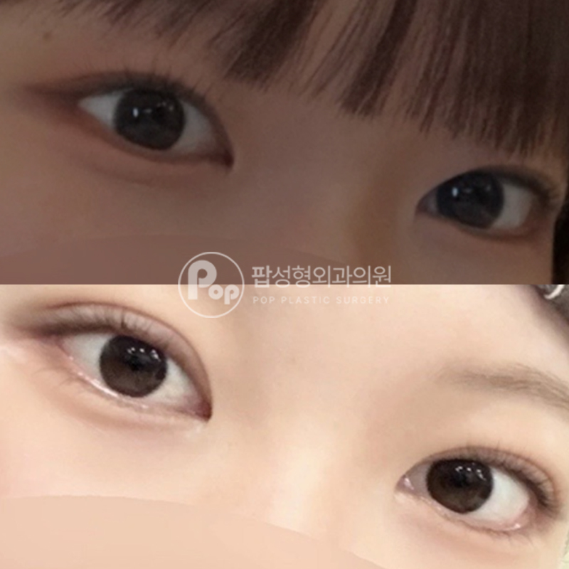 팝성형외과 풀린 라인 매몰 눈재수술 후기