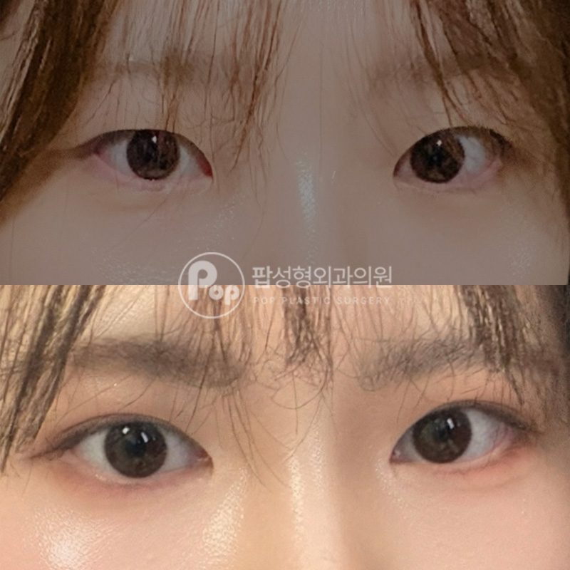 팝성형외과 졸린눈 자연유착 후기