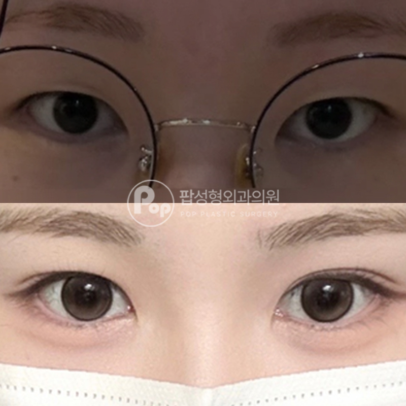 팝성형외과 자연스러운 쌍수 자연유착 후기