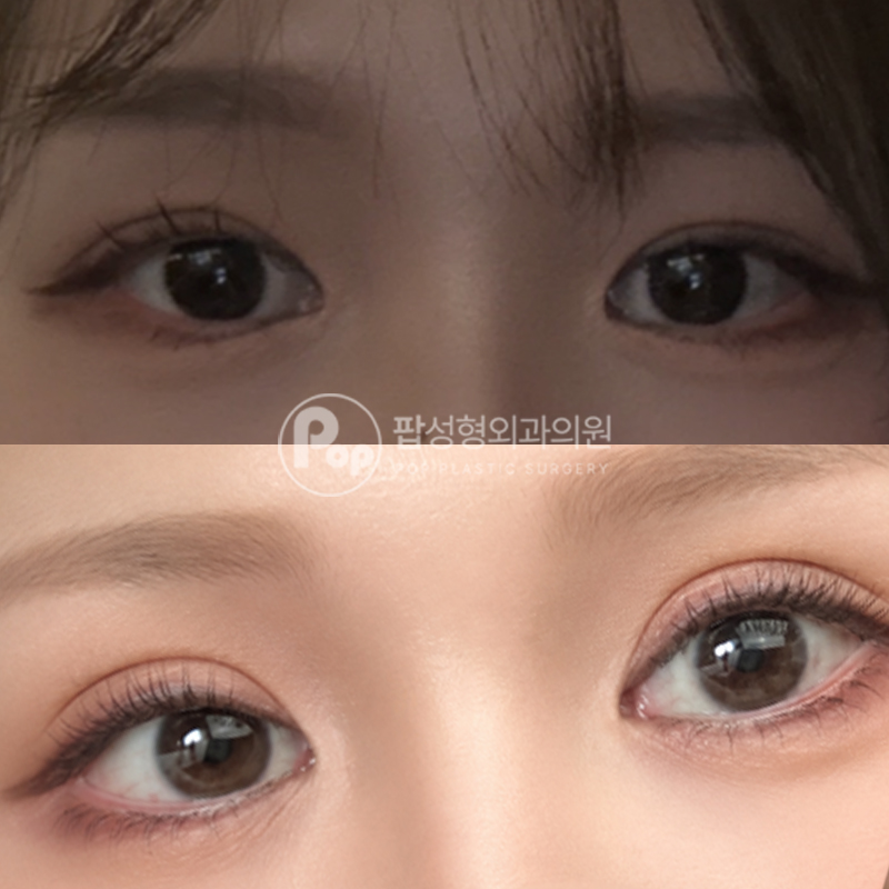 팝성형외과 라인높이기 눈재수술 후기