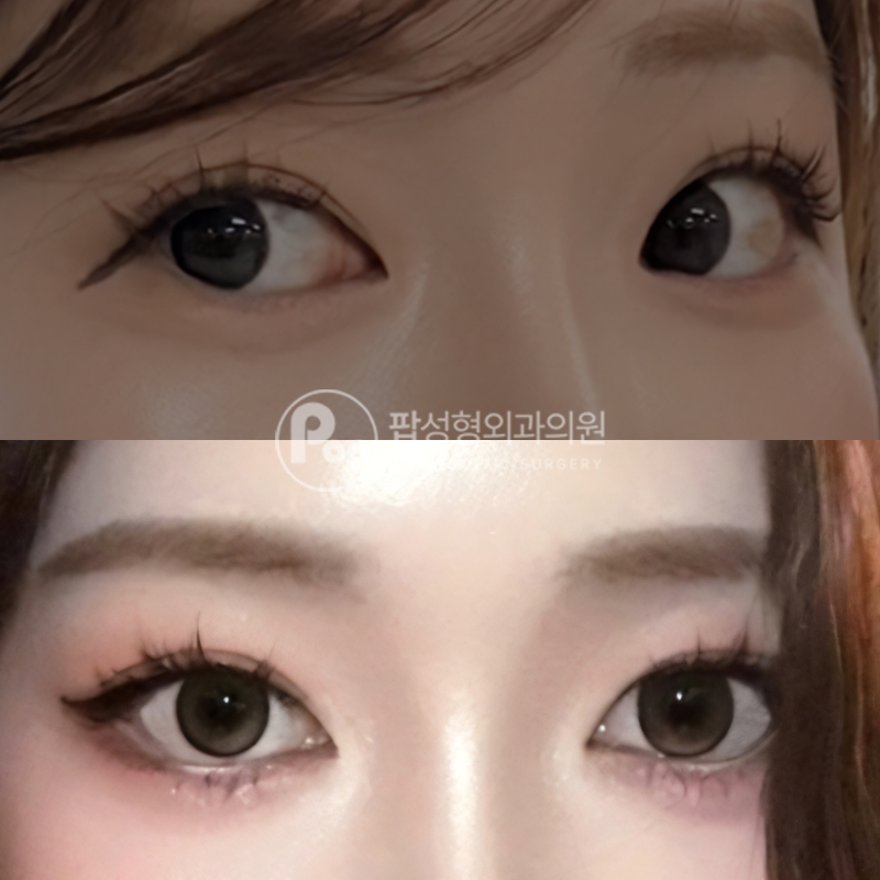 팝성형외과 비절개 뒤밑트임 후기