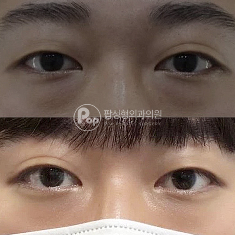 팝성형외과 남자 눈밑지방재배치 후기