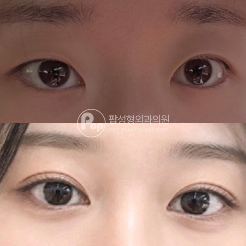팝성형외과 풀린눈 눈재수술 눈성형 후기