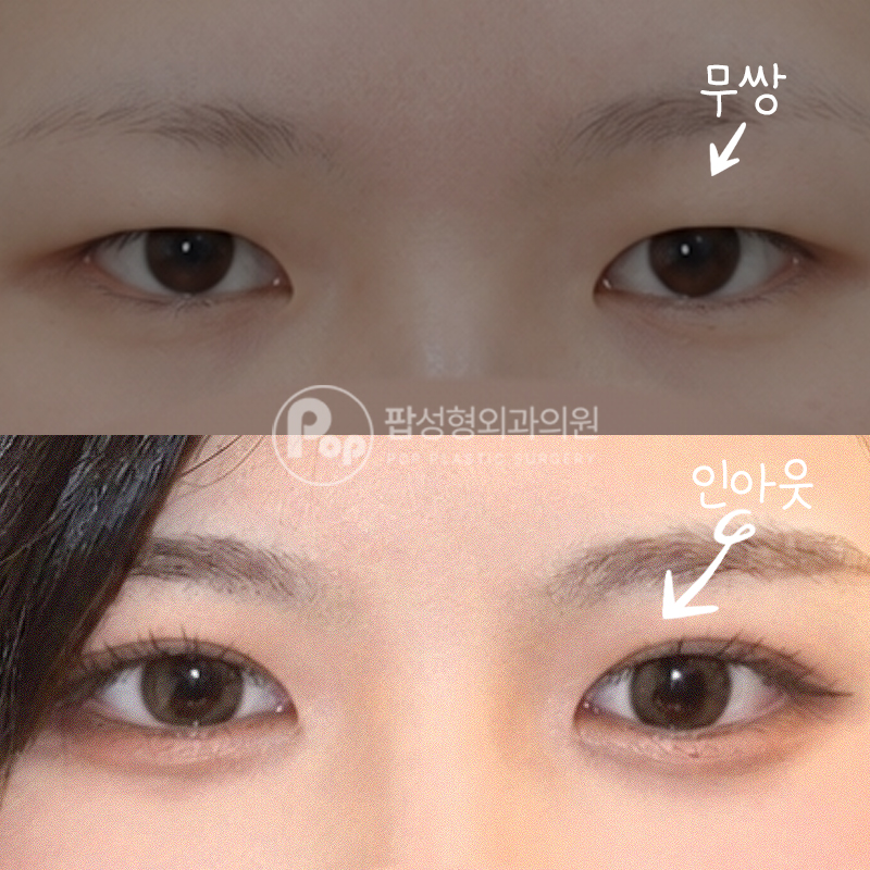 팝성형외과 무쌍 인아웃라인 쌍수 매몰 후기