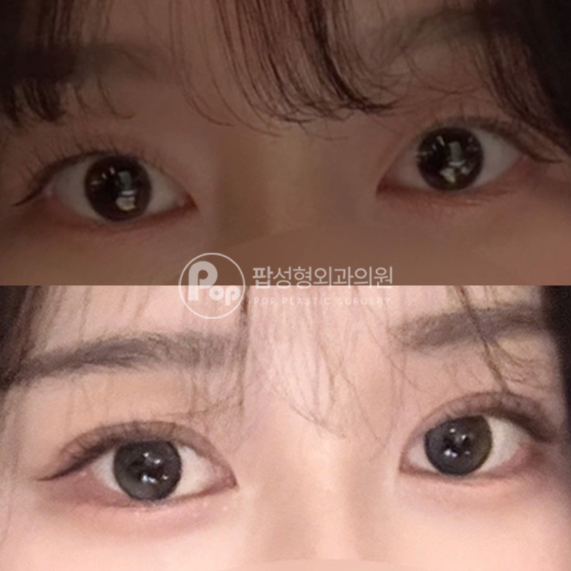 팝성형외과 첫 쌍수 눈성형 1개월차 후기