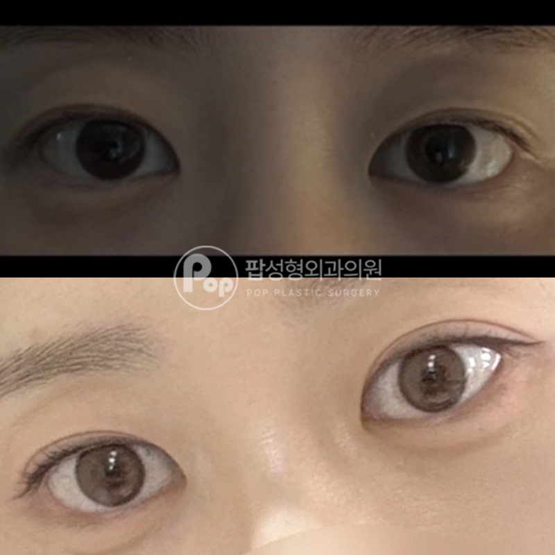 팝성형외과 인아웃라인 자연유착 후기