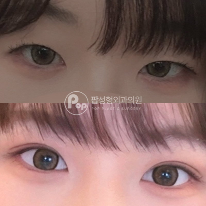 팝성형외과 인아웃라인 자연유착 쌍수 후기