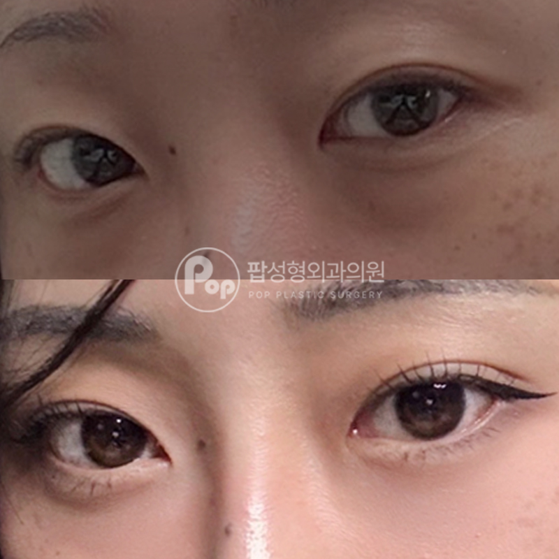 팝성형외과 인아웃 자연유착 윗트임 2달 후기