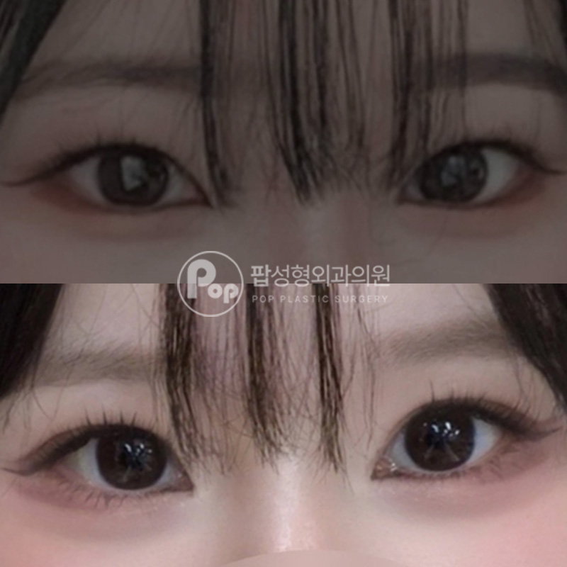 팝성형외과 낮아진 쌍꺼풀 재수술