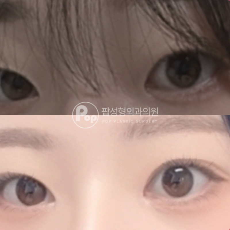 팝성형외과 무쌍 자연유착 눈성형 2개월차