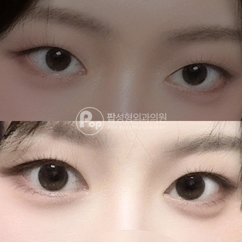 팝성형외과 인라인 자연유착 후기
