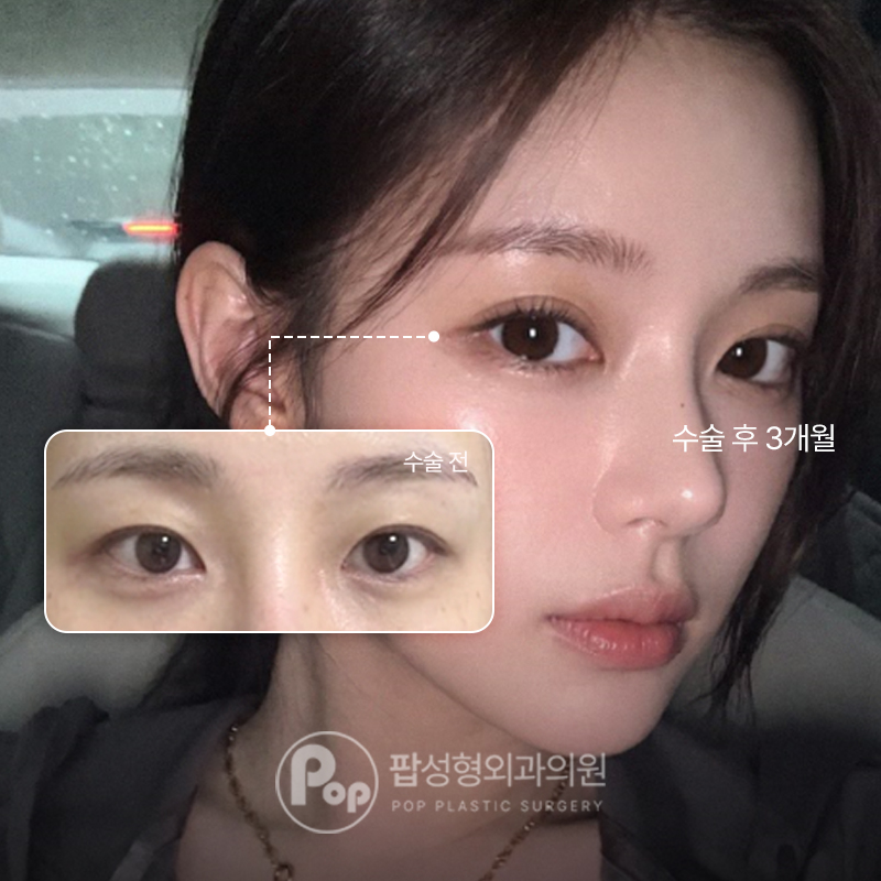 강남 팝성형외과 세미아웃 자연유착 쌍수 후기