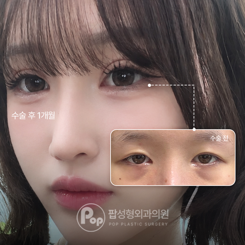 팝성형외과 눈재수술 졸린눈 눈밑지방재배치 후기