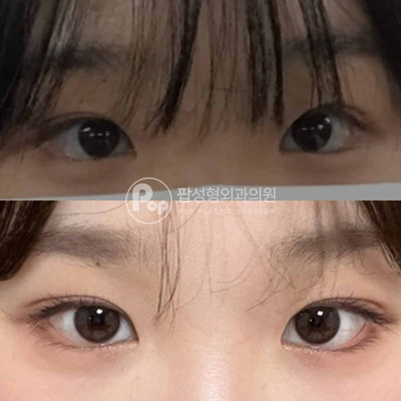 팝성형외과 눈성형 자연유착 쌍수 후기