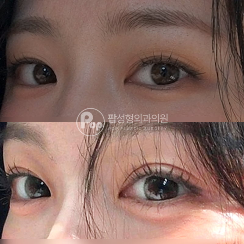 팝성형외과 무쌍 12홀 자연유착 후기
