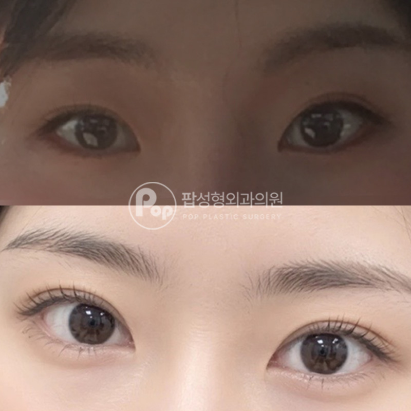 팝성형외과 풀린눈 눈재수술 1달차