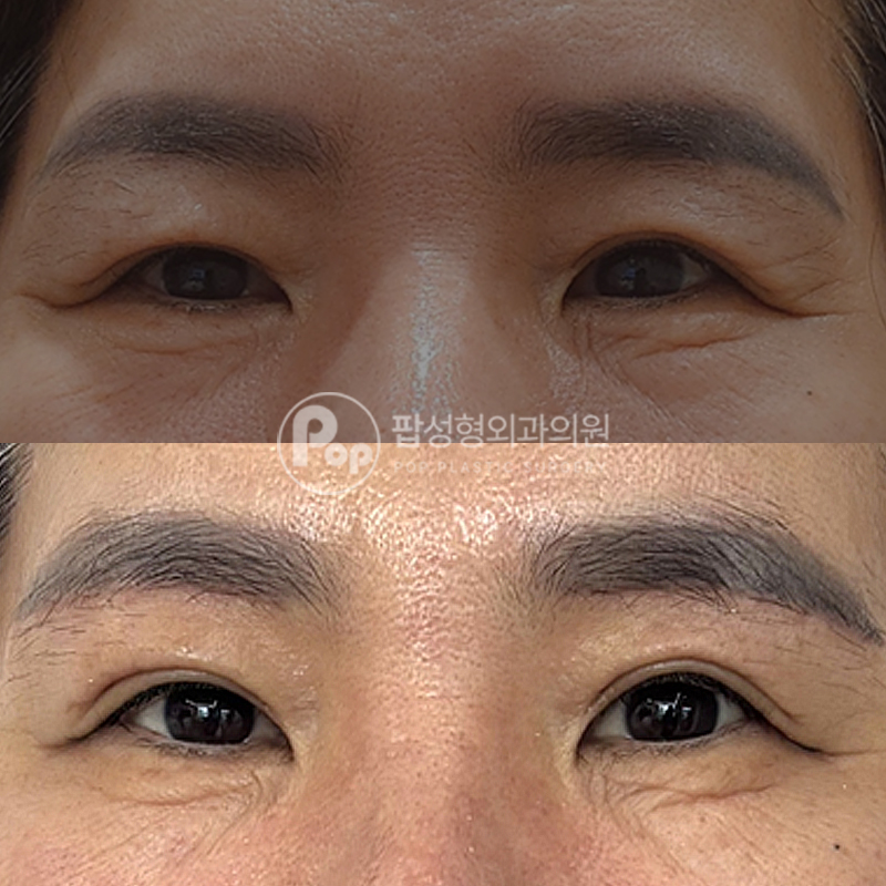 팝성형외과 중년 이마거상 후기