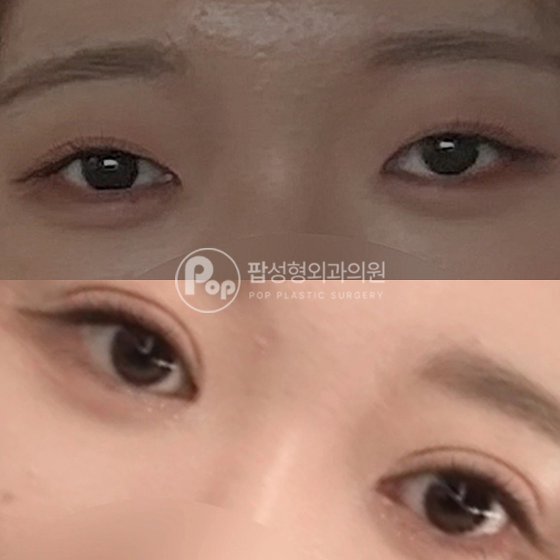 팝성형외과 졸린눈 자연유착 후기