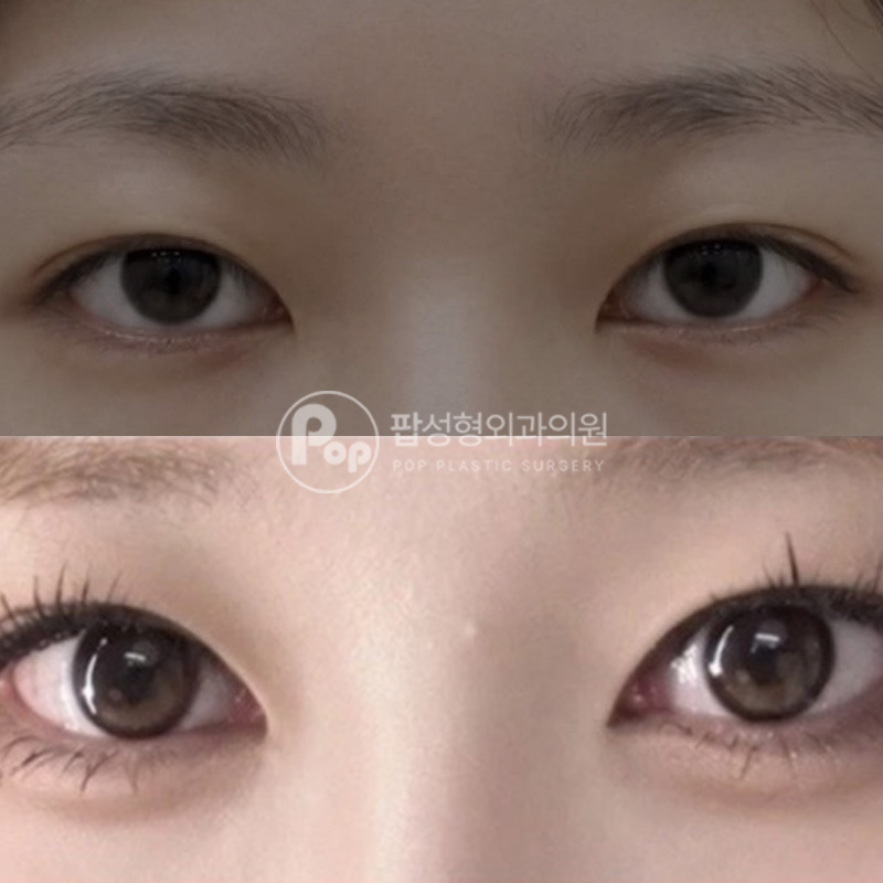 팝성형외과 몽고주름 앞트임