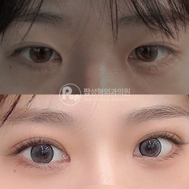 팝성형외과 라인 처짐 눈재수술 후기!