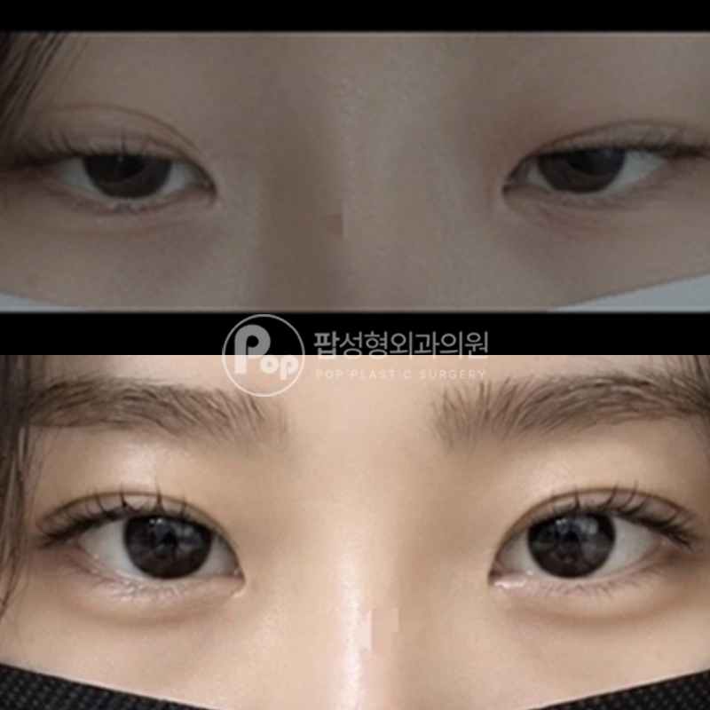 팝성형외과 절개 쌍커풀 눈재수술 눈성형 후기