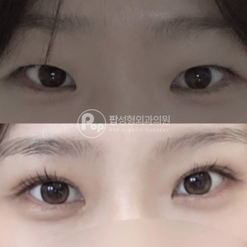 팝성형외과 작은눈 인아웃라인 2달차 후기