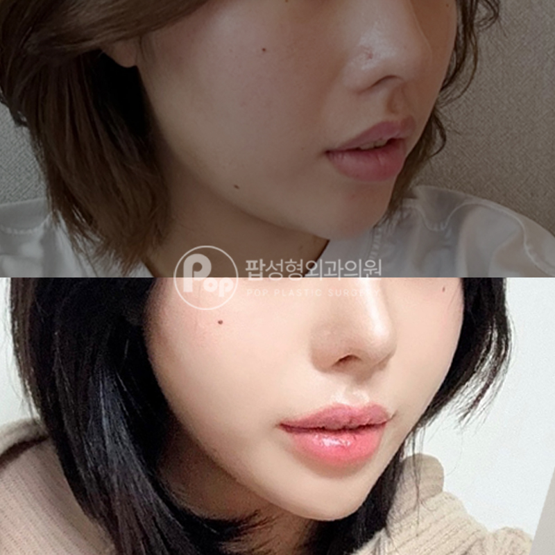 강남 팝성형외과 자연유착+실리프팅 6개월차 후기