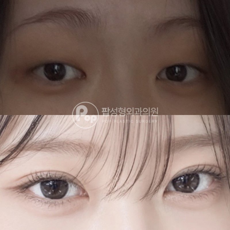 팝성형외과 무쌍에서 인아웃라인 쌍수 자연유착 후기