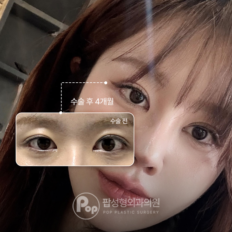 팝성형외과 비대칭라인 교정 눈재수술 후기