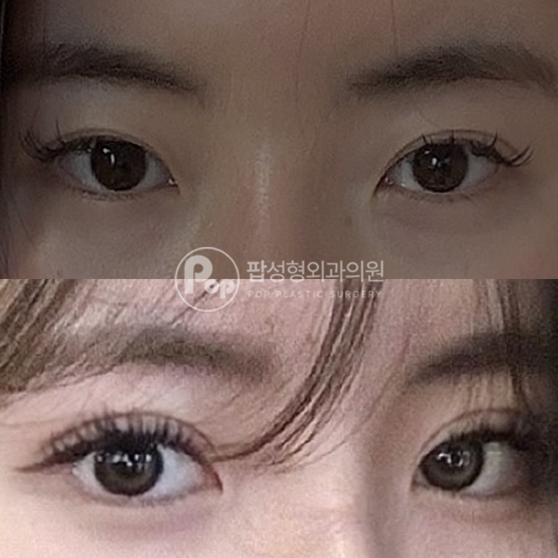 팝성형외과 눈재수술, 트임 눈성형 후기