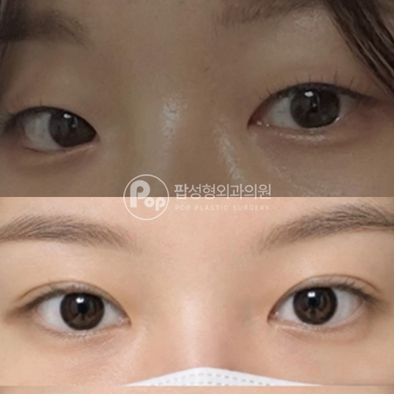 팝성형외과 인아웃라인 자연유착 후기