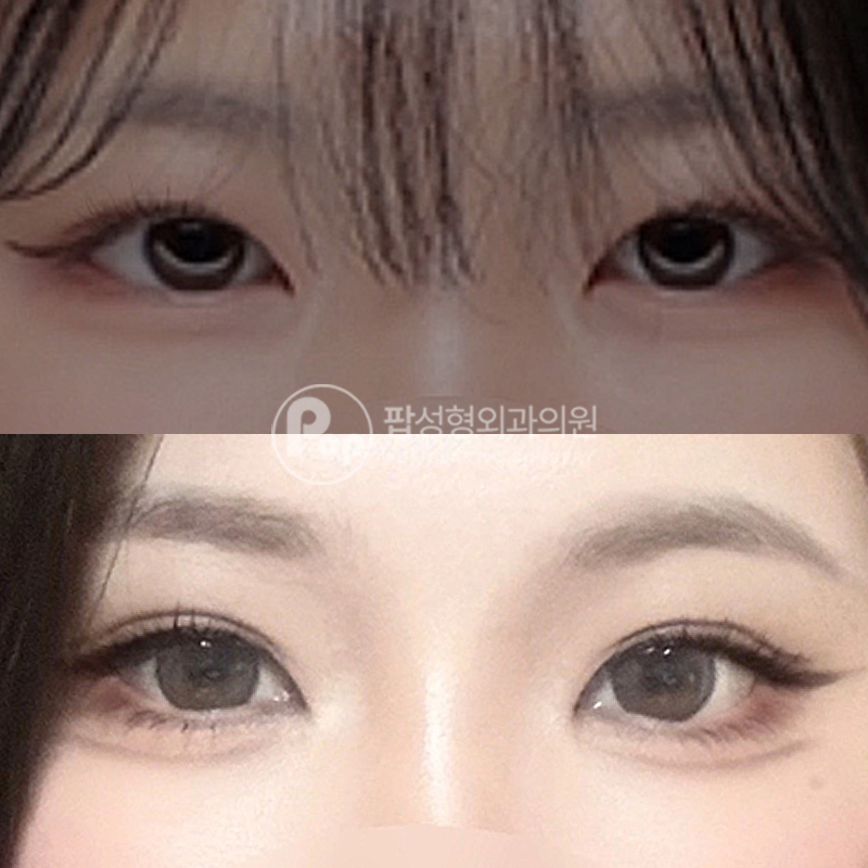 팝성형외과 낮은 쌍꺼풀 라인 자연유착 후기