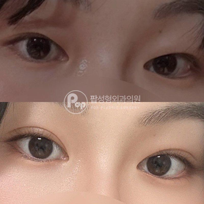 팝성형외과 비대칭라인 자연유착 후기