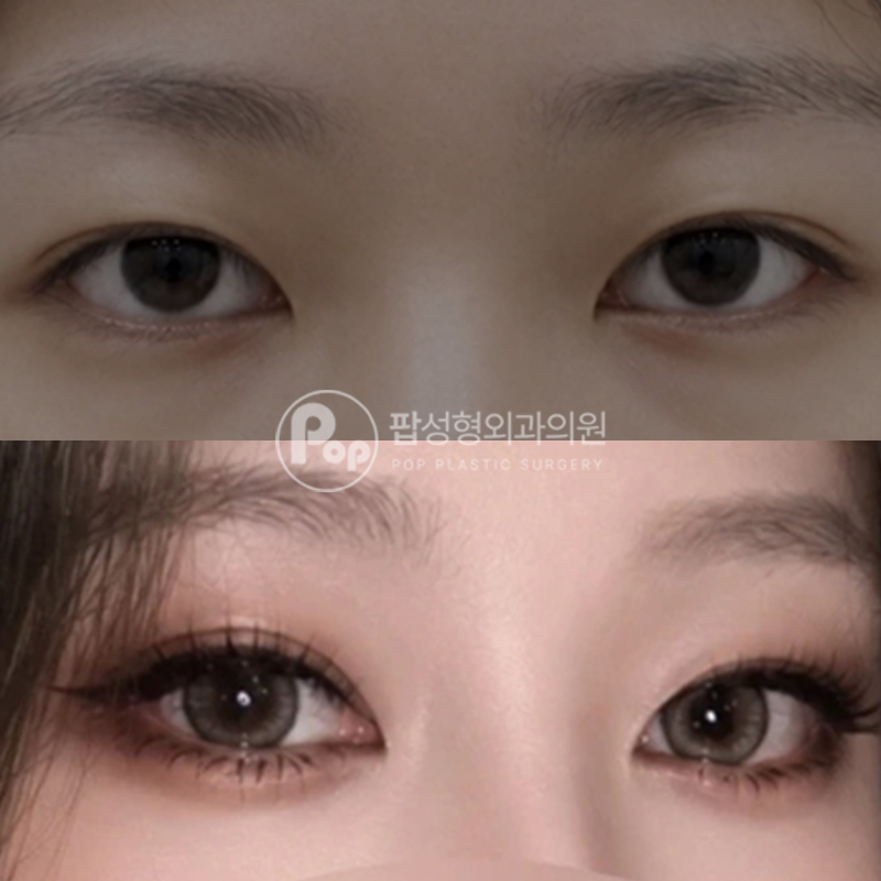 팝성형외과 몽고주름 앞트임 1개월차 후기