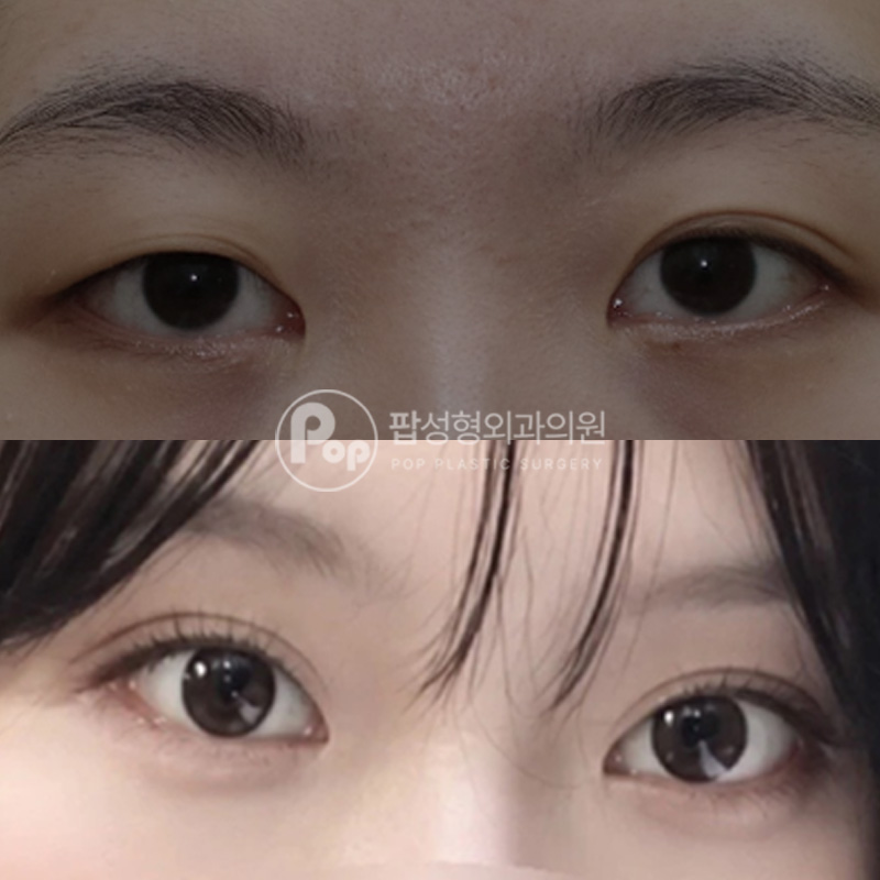 압구정 팝성형외과 세미아웃 눈재수술 눈성형