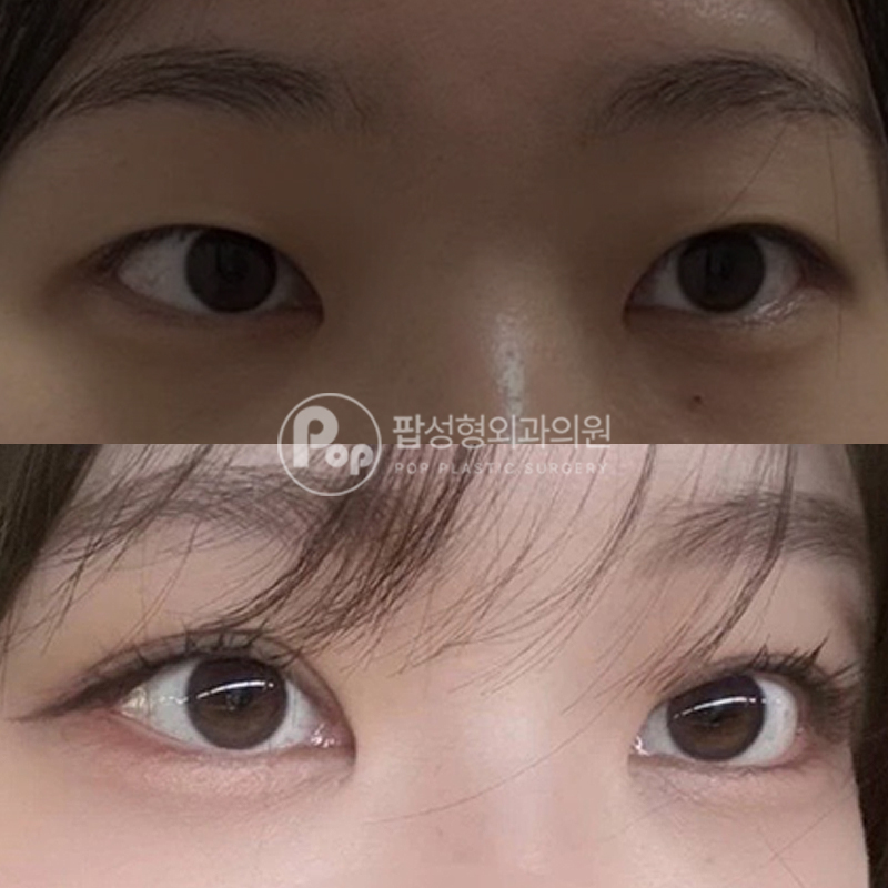 팝성형외과 비대칭 교정 자연유착 후기