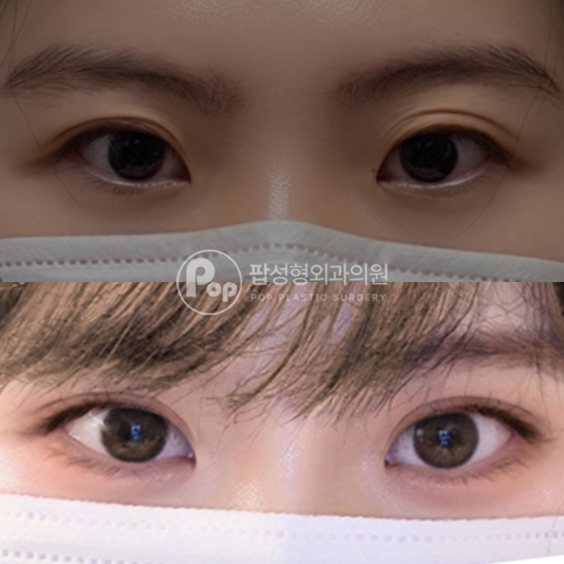 팝성형외과 겹쌍 세미아웃라인 후기