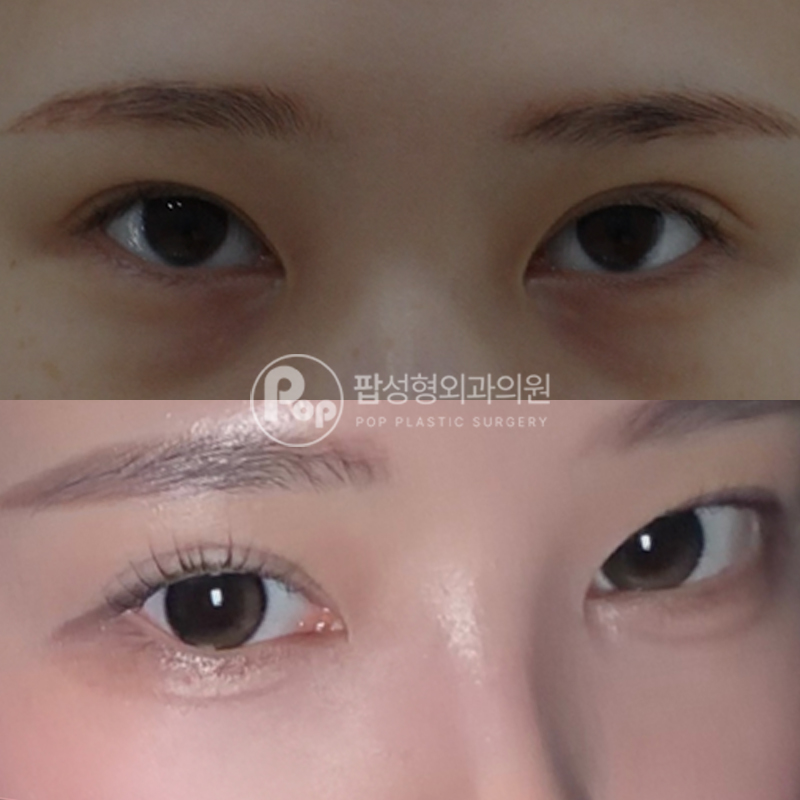 팝성형외과 눈밑지방재배치 1개월차 후기