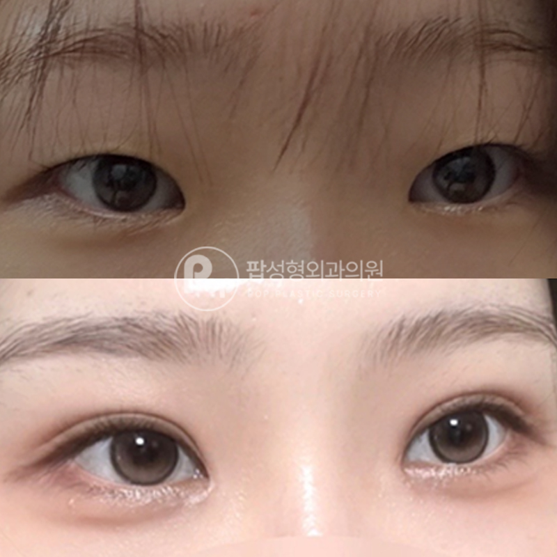 팝성형외과 무쌍 인아웃라인 자연유착 후기