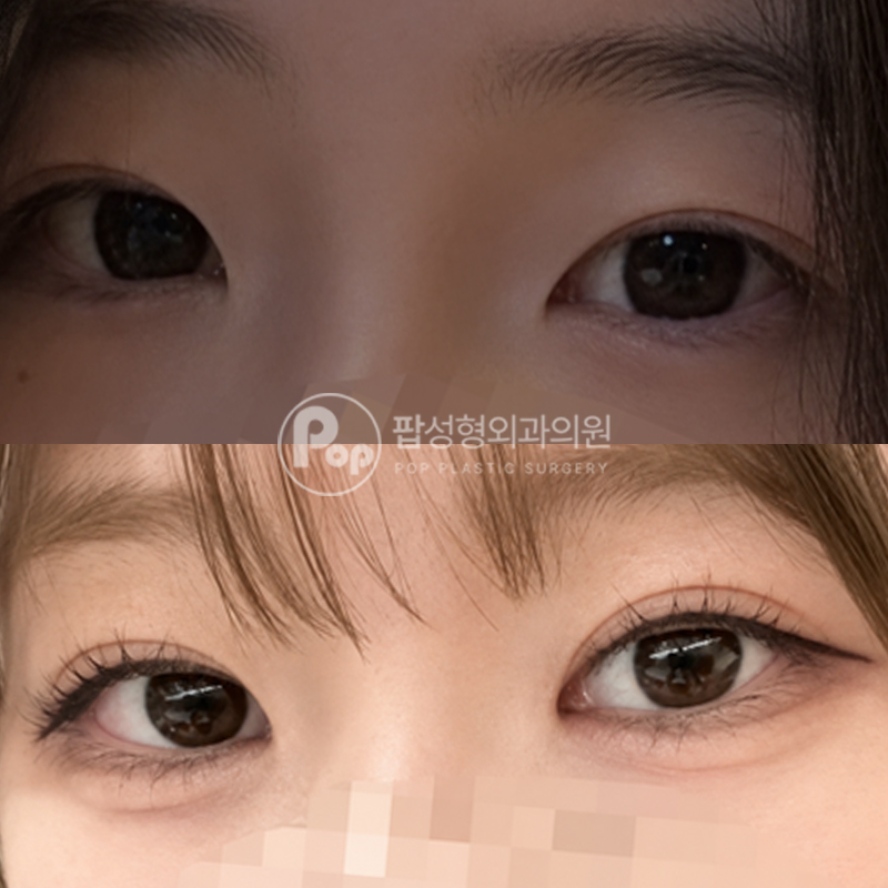 팝성형외과 라인높이기 눈재수술 후기