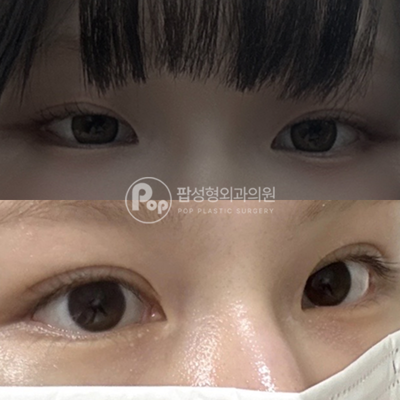 팝성형외과 낮은라인 눈재수술 후기
