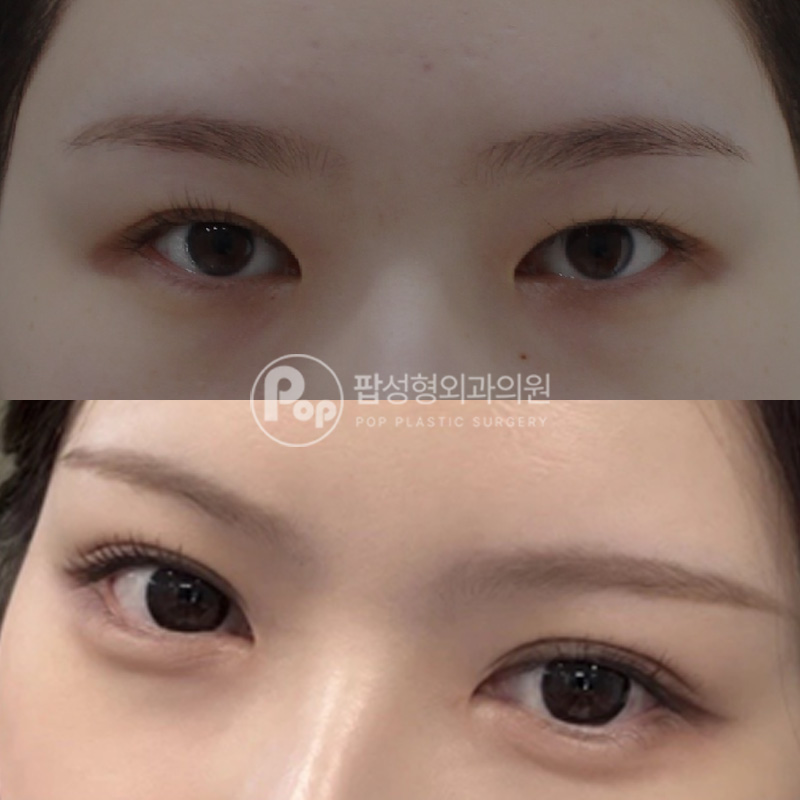 팝성형외과 풀린눈 재수술 후기