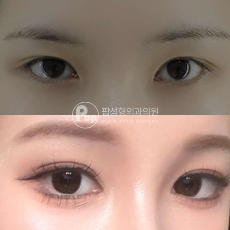 팝성형외과 이마거상 자연유착 후기