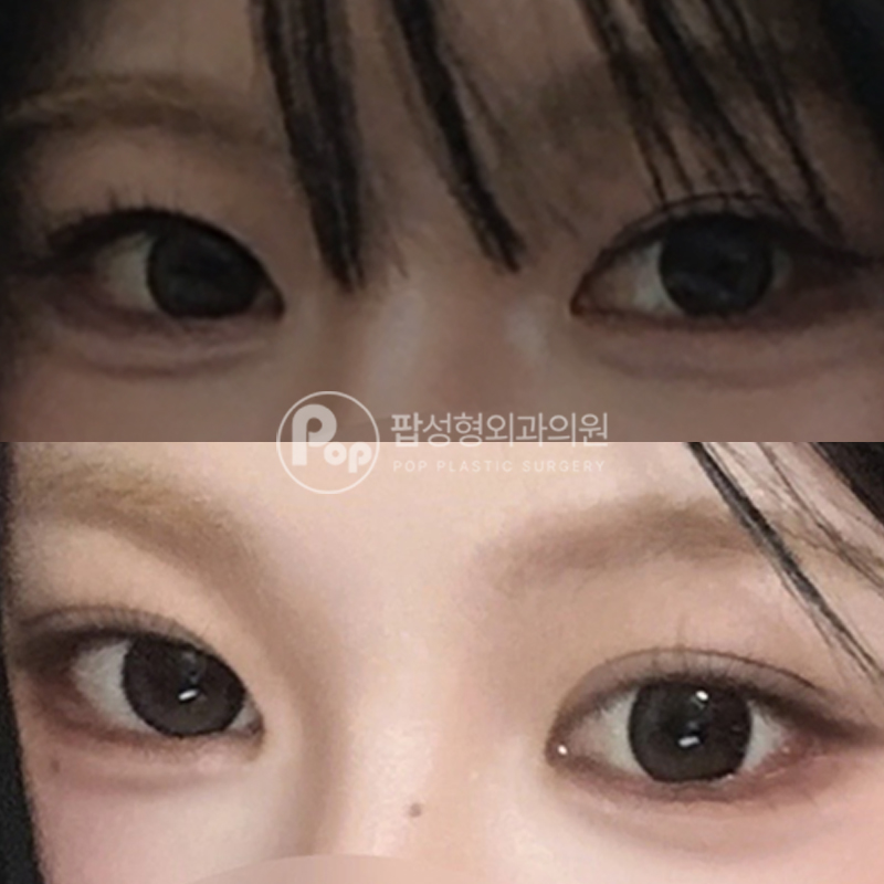 팝성형외과 낮은 라인 눈재수술 후기