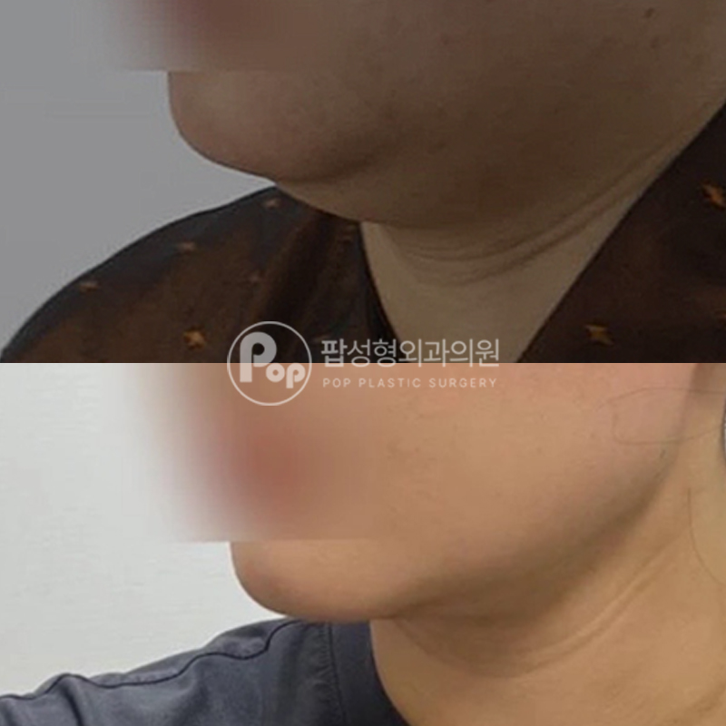 팝성형외과 이중턱 지방흡입+근육묶기 후기