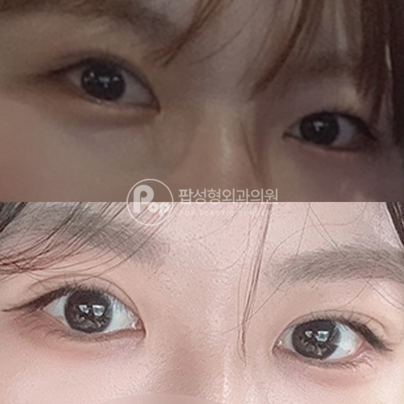 팝성형외과 짝눈 눈재수술 후기