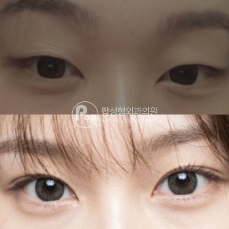 팝성형외과 무쌍 인아웃라인 쌍수 자연유착 후기