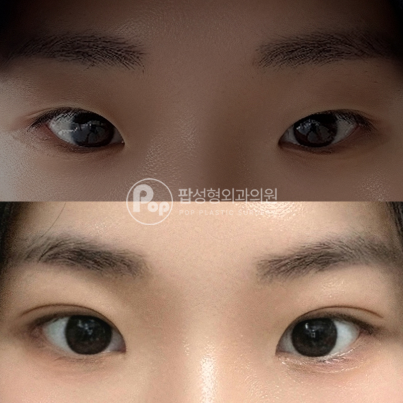 팝성형외과 졸린 눈 자연유착 후기